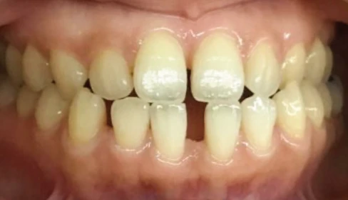 歯の隙間が気になる矯正歯科治療治療前