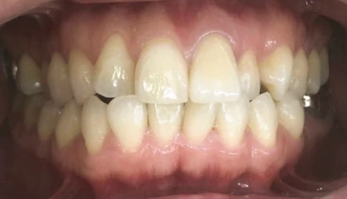 前歯の歯並びが気になる矯正歯科治療治療前