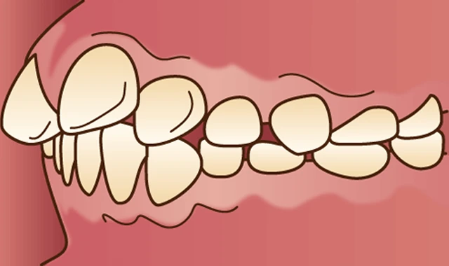 上顎前突 (出っ歯)