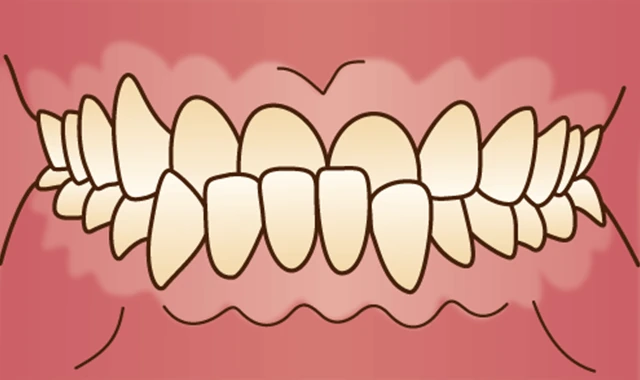 下顎前突 (受け口)
