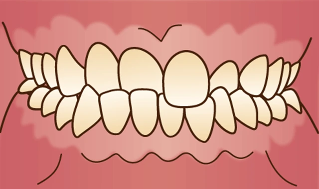 交叉咬合 (噛み合わせのズレ)