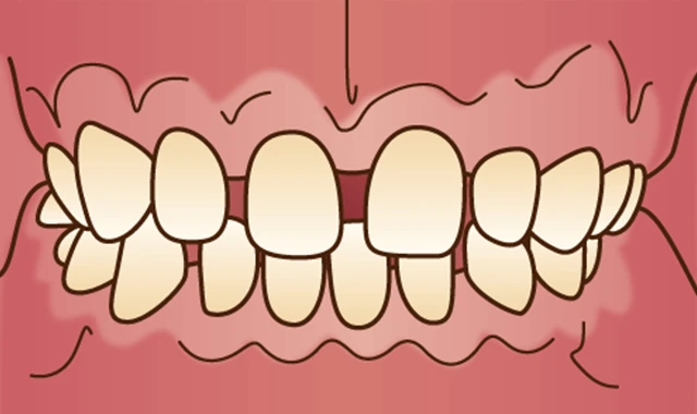 空隙歯列 (すきっ歯)