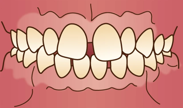 正中離開 (前歯のすきっ歯)