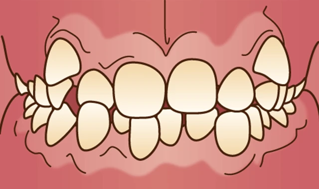 叢生・乱ぐい歯 (ガタガタ・八重歯)