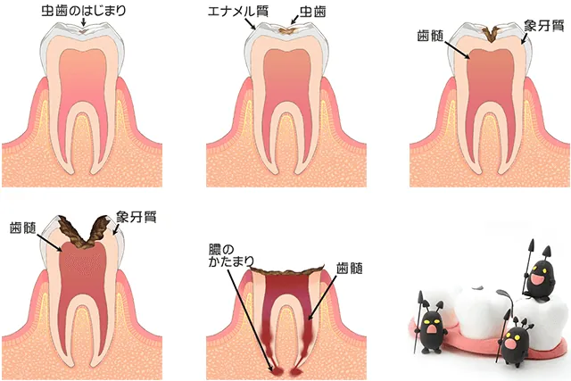 general-caries2