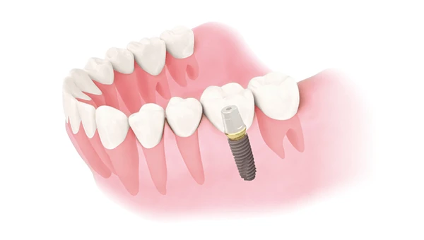 implant-1