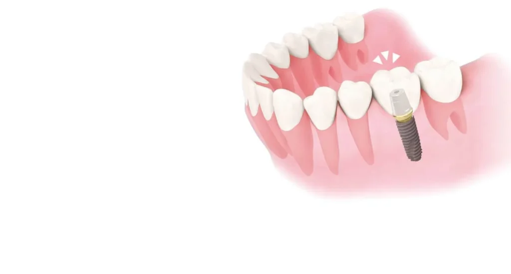 implant