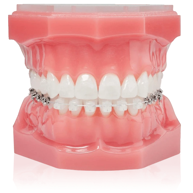 ortho-half-lingual