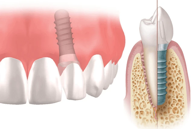 treatment-implant